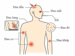 Dấu hiệu nhận biết mắc sốt xuất huyết và cách phòng tránh